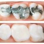 Dental Amalgams