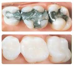 Dental Amalgams