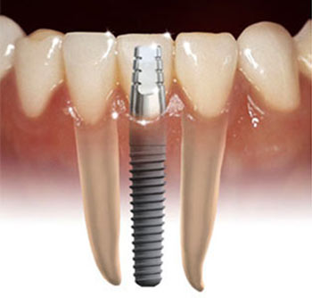 Facts about Dental Implants in Bayside NY