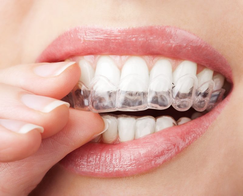 Straighten Your Smile Comfortably With Invisalign In Medina OH For Lasting Confidence