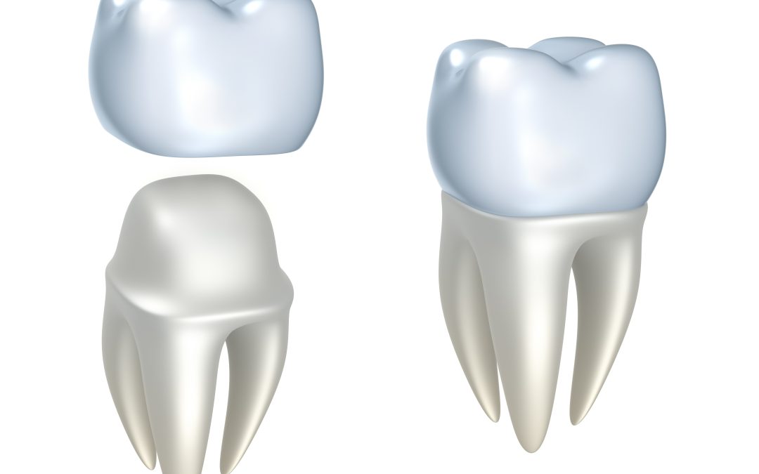 Restore Your Smile with Dental Crowns Madison WI Can Trust for Lasting Results