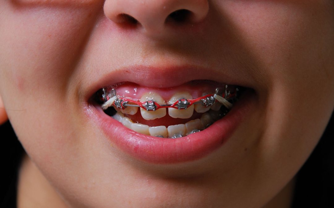Benefits of Early Braces Consultation with an Orthodontist in Medina OH for Kids